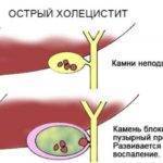 Острый холецистит - виды, симптомы и лечение, неотложная помощь