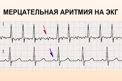 Классификация фибрилляции предсердий