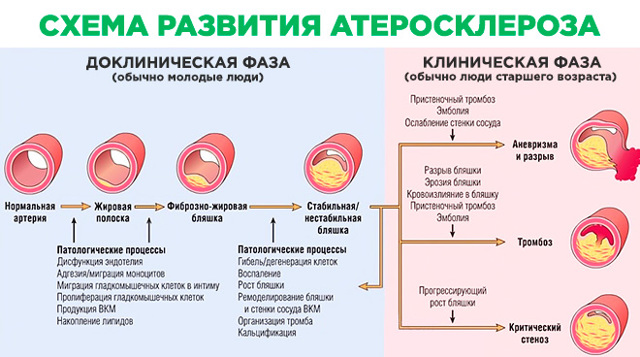 В сосудах бляшки: диагностика и терапия