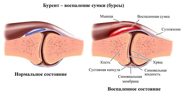 Болит вена на пальце: что это - ответы и советы на твои вопросы