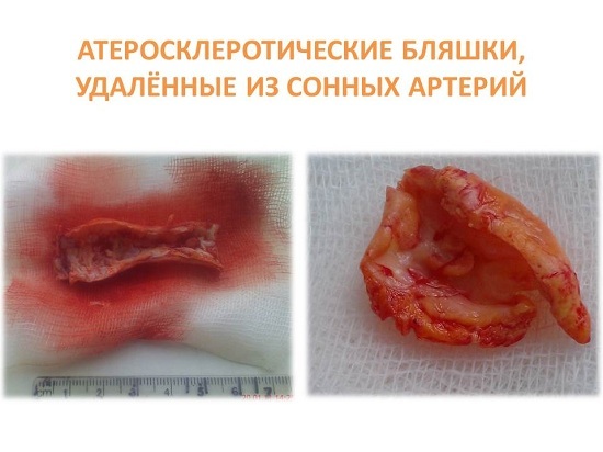 Внутренняя сонная артерия