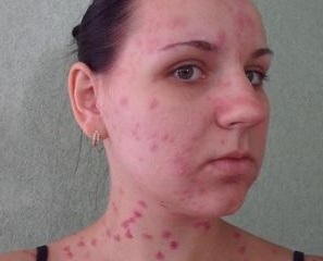Ветрянка у взрослых симптомы и лечение