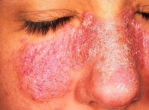 Волчанка - причины, признаки и симптомы, лечение