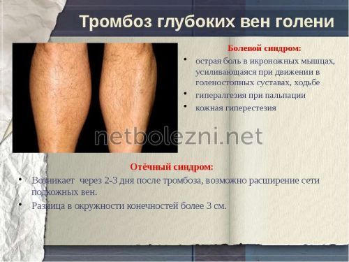 Тромб в ноге – причины, симптомы и лечение