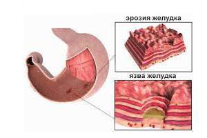 Кровь в желудке: причины и симптомы, диагностика и лечение