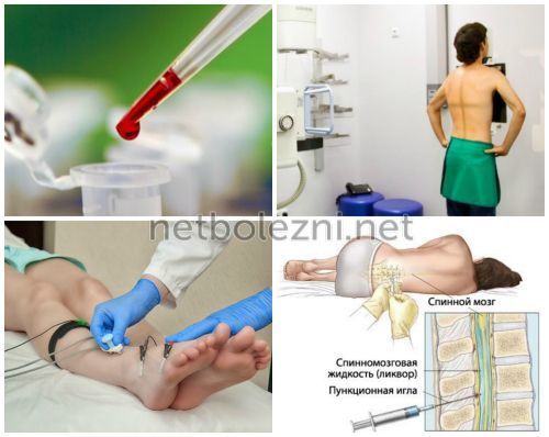 Мазь при полинейропатии нижних конечностей: классификация, медикаменты, народные средства, проявления