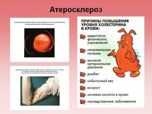 Можно ли пить алкоголь при атеросклерозе? - Диабет - 100 бед