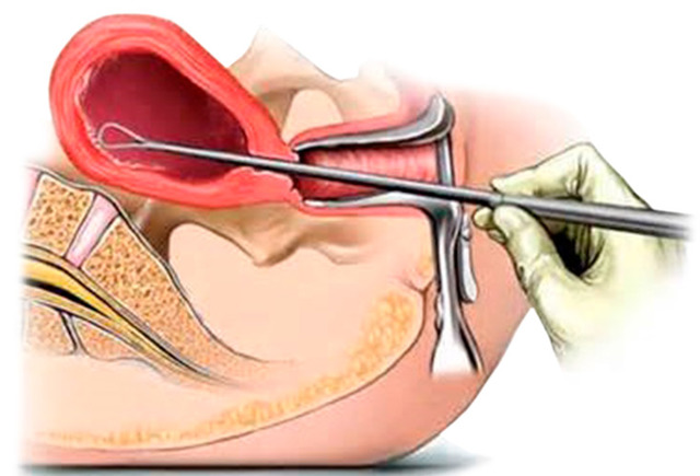 Сколько дней идёт кровь после выскабливания - выделения после гистероскопии и чистки матки, последствия, месячные