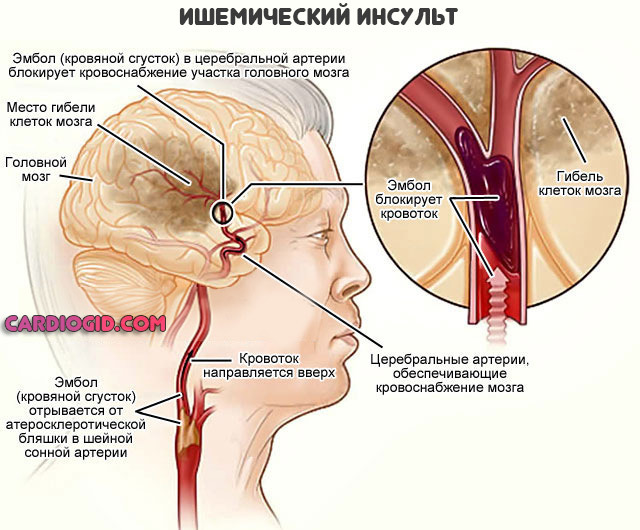 Инсульт левая или правая сторона, последствия, сколько живут