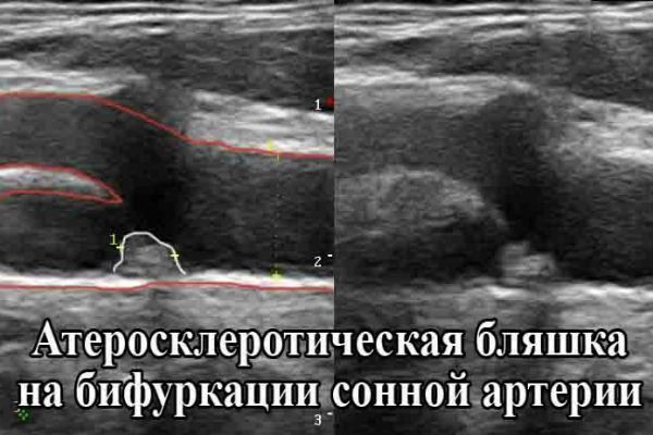 Допплерография Сосудов Шеи и Головы как Метод Диагностики