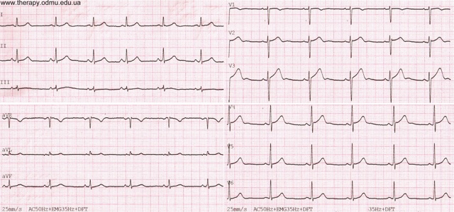 Стандартные отведения от конечностей - 1,2,3