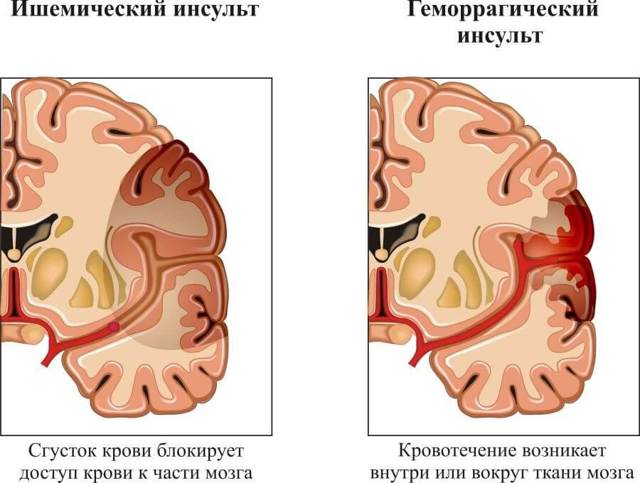 Скачет давление (то низкое, то высокое): что делать, причины, признаки