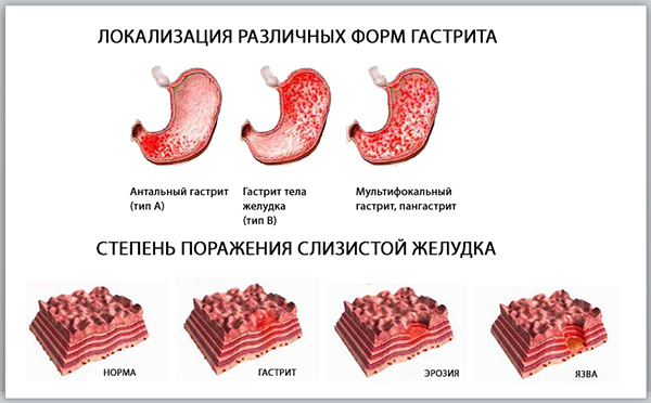 Покалывание в верхней части грудной клетки