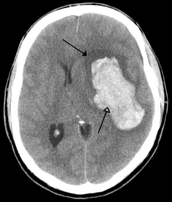Сопор и кома при инсульте - Инсульт . Реабилитация