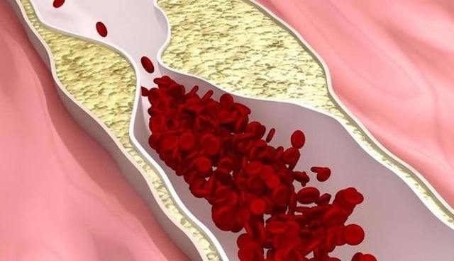 Выбираем препараты для чистки сосудов от холестерина