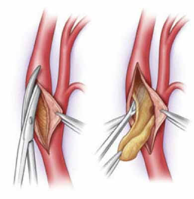 Тромб в сонной артерии: лечение, симптомы и удаление