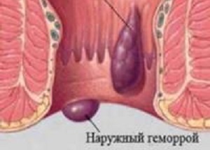 УЛЬТРАПРОКТ - инструкция по применению, цена, отзывы и аналоги
