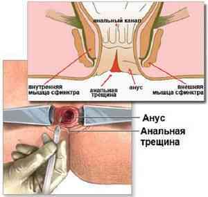 Трещина прямой кишки - симптомы, лечение