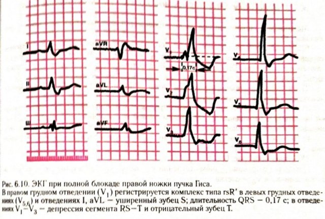Чем опасна блокада ножек пучка гиса и как ее лечить