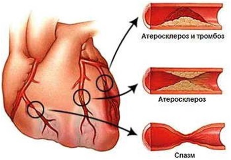 Как отличить сердечную боль от остеохондроза