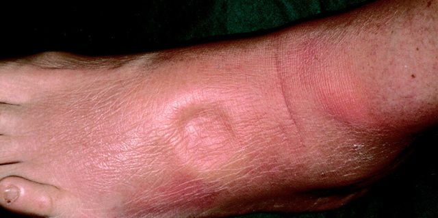 Отеки при сердечной недостаточности: симптомы, патогенез, лечение