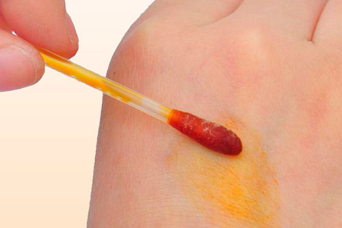 Лечение гипертонии йодом (по индийскому методу)