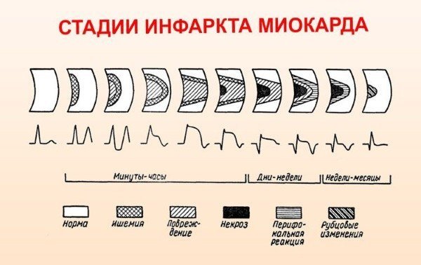 Сколько лежат в реанимации после инфаркта и на сколько дней дают больничный