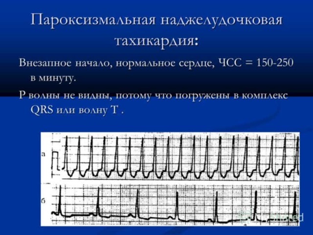 Причины пароксизмальной. Наджелудочковая пароксизмальная тахикардия на ЭКГ. Пароксизмальная тахикардия причины