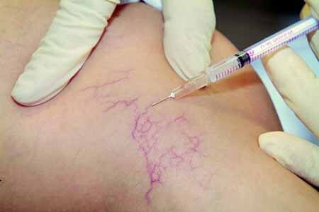 Осложнения и последствия после склеротерапии