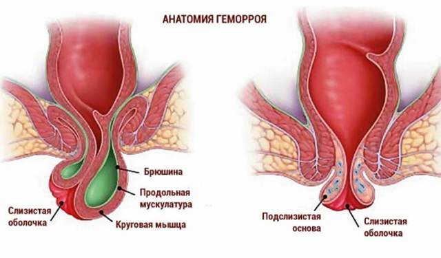 Геморрой - причины, симптомы, диагностика и лечение