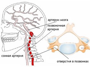 Асимметрия v4 сегментов позвоночных артерий d s. Можно ли вылечить синдром позвоночной артерии при остеохондрозе