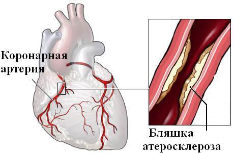 Когда переживаю болит сердце