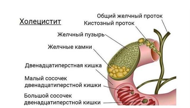 Хронический холецистит симптомы и лечение диета народные средства