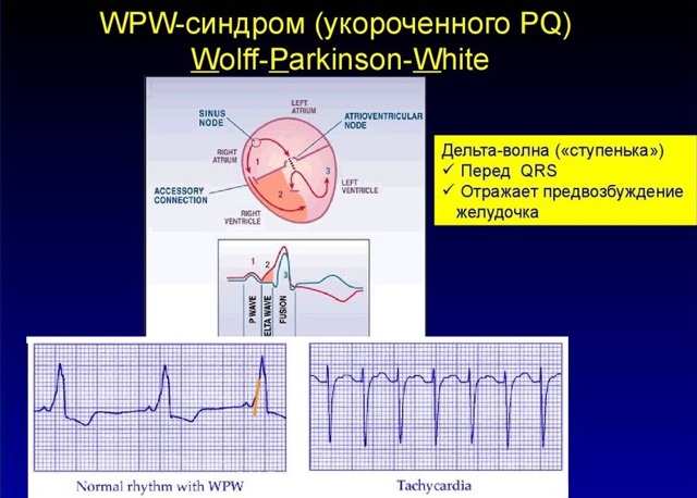 Синдром укороченного PQ: причины, симптомы, лечение