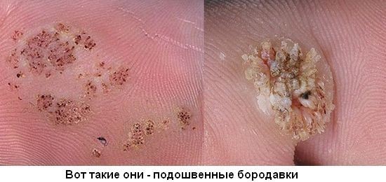 Что такое бородавка и как с ней бороться?