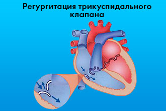 Регургитация трикуспидального клапана 1 степени