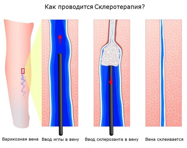Склеротерапия вен нижних конечностей: плюсы и минусы