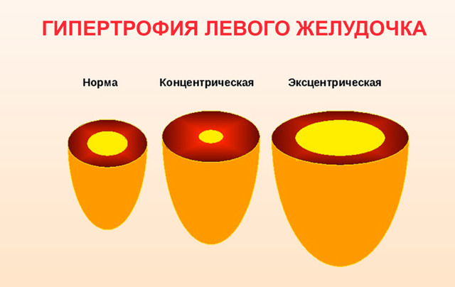 Изменение миокарда левого желудочка: что это такое, диффузный и неспецифический вид