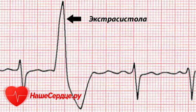 Экстрасистолия сердца: лечение, симптомы