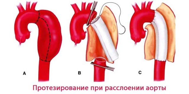 Расслоение аорты — Симптом Инфо