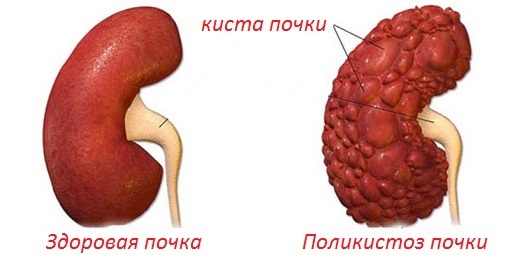 Реноваскулярная гипертензия - лечение, причины
