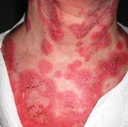 Волчанка - причины, признаки и симптомы, лечение