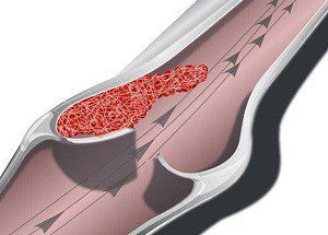 Застой в малом тазу у мужчин симптомы. Венозный застой крови в малом тазу и его последствия