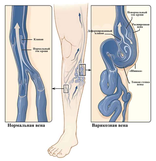 Варикоз, варикозное расширение вен ног: лечение, симптомы