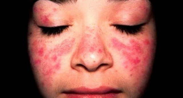 Системная красная волчанка при беременности. Системная красная волчанка и беременность