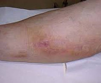 Флебит вены на руке. Лечение постинъекционного флебита после катетера