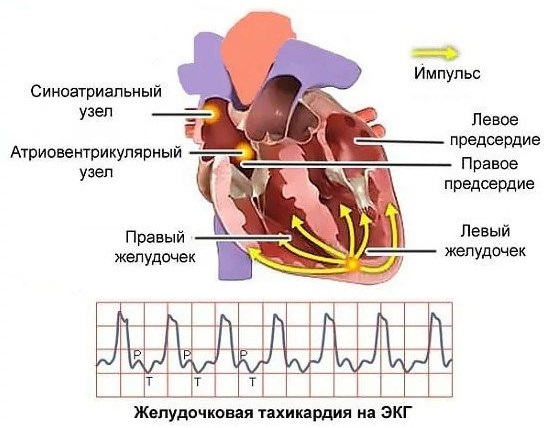 Желудочковая тахикардия на экг