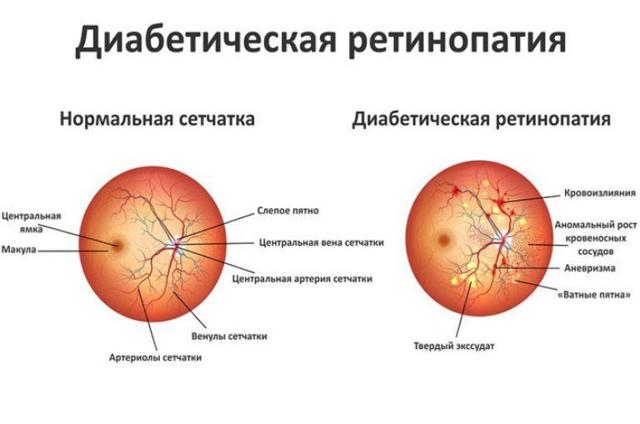 Ангиопатия сетчатки обоих глаз - что это такое и как лечить?