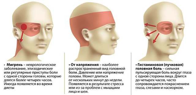 Всё о головной боли: характер, виды, первичная, вторичная