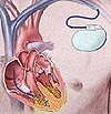 Установка кардиостимулятора сердца - цена: операция по установке кардиостимулятора, стоимость в СПб